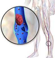 clot